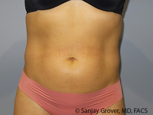 Liposuction Before and After 21 | Sanjay Grover MD FACS
