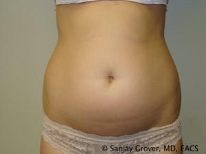 Liposuction Before and After 14 | Sanjay Grover MD FACS