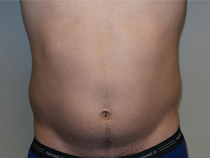 Liposuction Before and After 33 | Sanjay Grover MD FACS