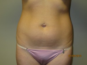 Liposuction Before and After 58 | Sanjay Grover MD FACS