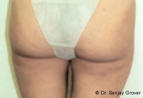 Liposuction Before and After 57 | Sanjay Grover MD FACS