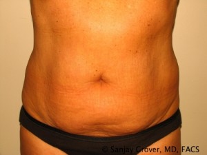Liposuction Before and After 12 | Sanjay Grover MD FACS