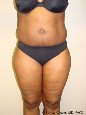 Liposuction Before and After 34 | Sanjay Grover MD FACS