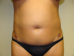 Liposuction Before and After 56 | Sanjay Grover MD FACS