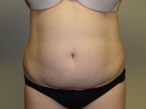 Liposuction Before and After 55 | Sanjay Grover MD FACS