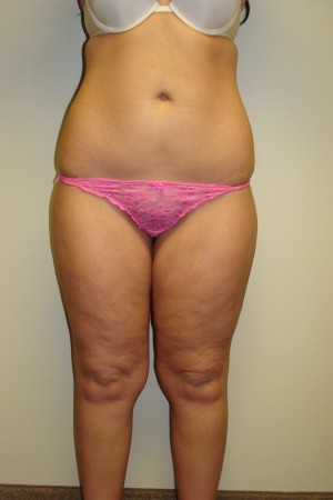 Liposuction Before and After 15 | Sanjay Grover MD FACS