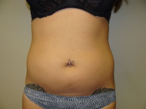 Liposuction Before and After 12 | Sanjay Grover MD FACS