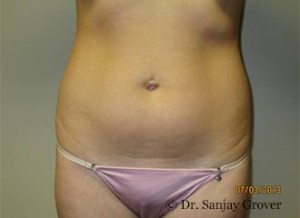 Liposuction Before and After 61 | Sanjay Grover MD FACS