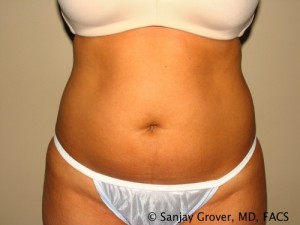 Liposuction Before and After 21 | Sanjay Grover MD FACS