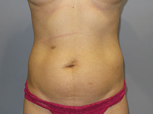 Liposuction Before and After 61 | Sanjay Grover MD FACS