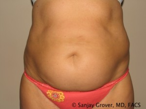 Tummy Tuck Before and After 67 | Sanjay Grover MD FACS