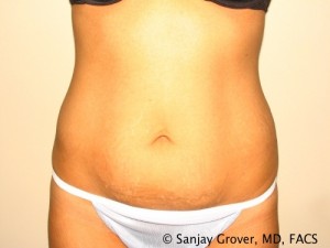 Tummy Tuck Before and After 82 | Sanjay Grover MD FACS
