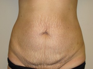 Tummy Tuck Before and After 29 | Sanjay Grover MD FACS