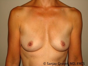 Breast Augmentation Before and After 78 | Sanjay Grover MD FACS