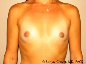 Breast Augmentation Before and After 158 | Sanjay Grover MD FACS