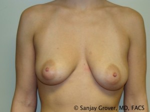 Breast Augmentation Before and After 31 | Sanjay Grover MD FACS