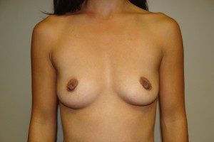 Breast Augmentation Before and After 232 | Sanjay Grover MD FACS