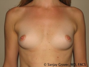 Breast Augmentation Before and After 266 | Sanjay Grover MD FACS