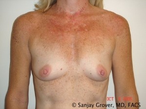 Breast Augmentation Before and After 168 | Sanjay Grover MD FACS