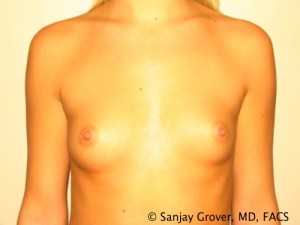 Breast Augmentation Before and After 66 | Sanjay Grover MD FACS
