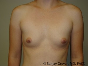 Breast Augmentation Before and After 129 | Sanjay Grover MD FACS