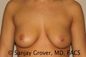 Breast Augmentation Before and After 54 | Sanjay Grover MD FACS