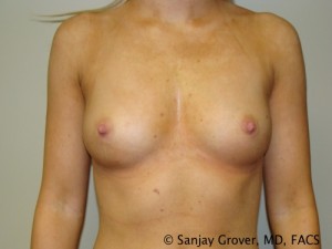 Breast Augmentation Before and After 299 | Sanjay Grover MD FACS