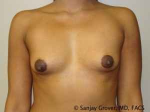Breast Augmentation Before and After 13 | Sanjay Grover MD FACS