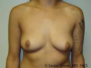 Breast Augmentation Before and After 05 | Sanjay Grover MD FACS