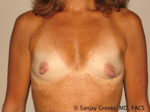 Breast Augmentation Before and After 89 | Sanjay Grover MD FACS