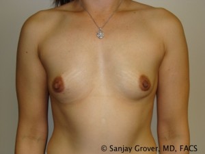 Breast Augmentation Before and After 299 | Sanjay Grover MD FACS
