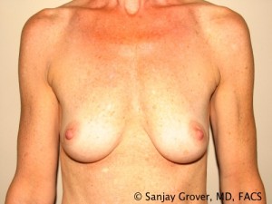 Breast Augmentation Before and After 75 | Sanjay Grover MD FACS