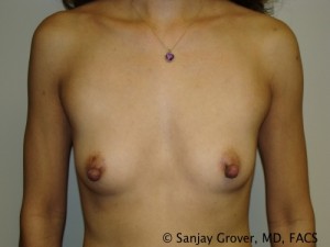 Breast Augmentation Before and After 74 | Sanjay Grover MD FACS