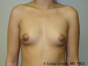 Breast Augmentation Before and After 154 | Sanjay Grover MD FACS