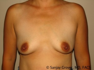 Breast Augmentation Before and After 80 | Sanjay Grover MD FACS