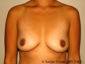 Breast Augmentation Before and After 54 | Sanjay Grover MD FACS