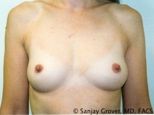Breast Augmentation Before and After 37 | Sanjay Grover MD FACS