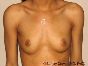 Breast Augmentation Before and After 49 | Sanjay Grover MD FACS
