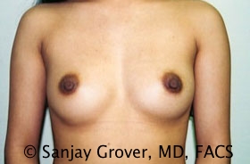 Breast Augmentation Before and After 290 | Sanjay Grover MD FACS