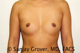 Breast Augmentation Before and After 69 | Sanjay Grover MD FACS