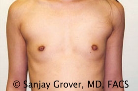 Breast Augmentation Before and After 172 | Sanjay Grover MD FACS