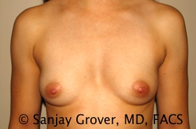 Breast Augmentation Before and After 103 | Sanjay Grover MD FACS