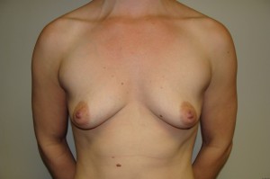 Breast Augmentation Before and After 35 | Sanjay Grover MD FACS