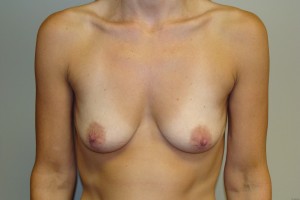 Breast Augmentation Before and After 287 | Sanjay Grover MD FACS