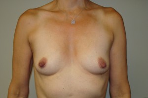 Breast Augmentation Before and After 248 | Sanjay Grover MD FACS