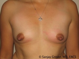 Breast Augmentation Before and After 204 | Sanjay Grover MD FACS