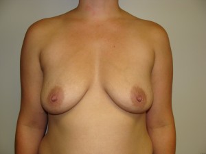 Breast Augmentation Before and After 257 | Sanjay Grover MD FACS
