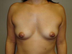 Breast Augmentation Before and After 168 | Sanjay Grover MD FACS
