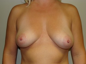 Breast Augmentation Before and After 229 | Sanjay Grover MD FACS