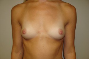 Breast Augmentation Before and After 90 | Sanjay Grover MD FACS